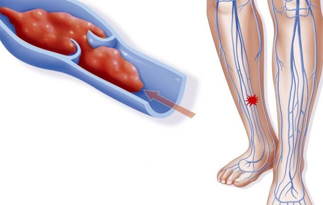 Thrombophlbitbitis