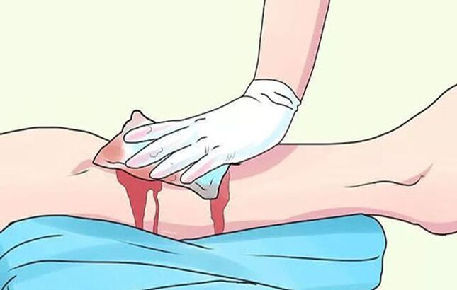 Venous Blutungen