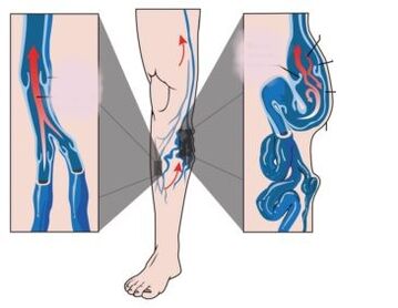 Ursaachen, Symptomer