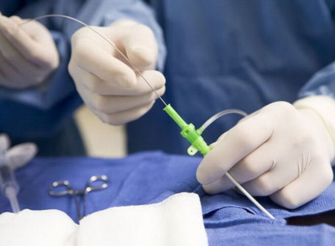 Radiofrequenz Ablatioun